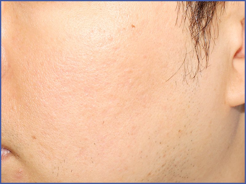 Depressed acne scars after treatment at Yonsei Star Dermatology