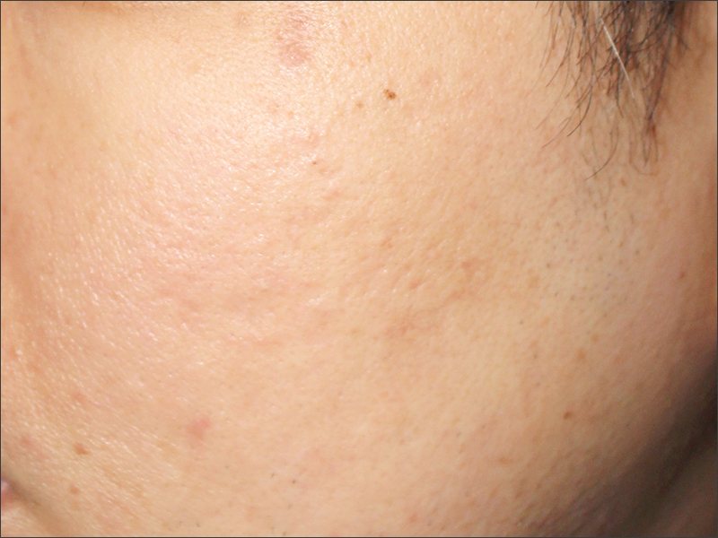 Depressed acne scars before treatment at Yonsei Star Dermatology