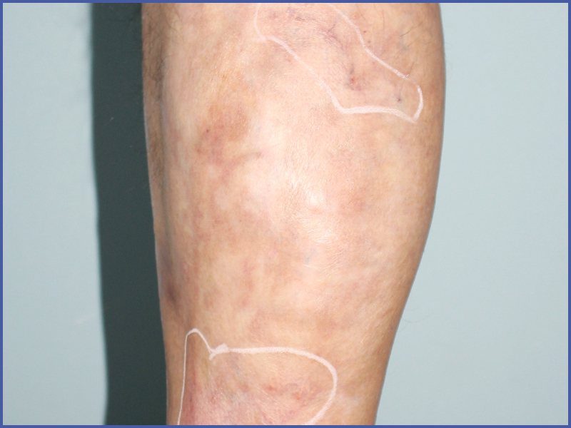 Burn scar after treatment at Yonsei Star Dermatology