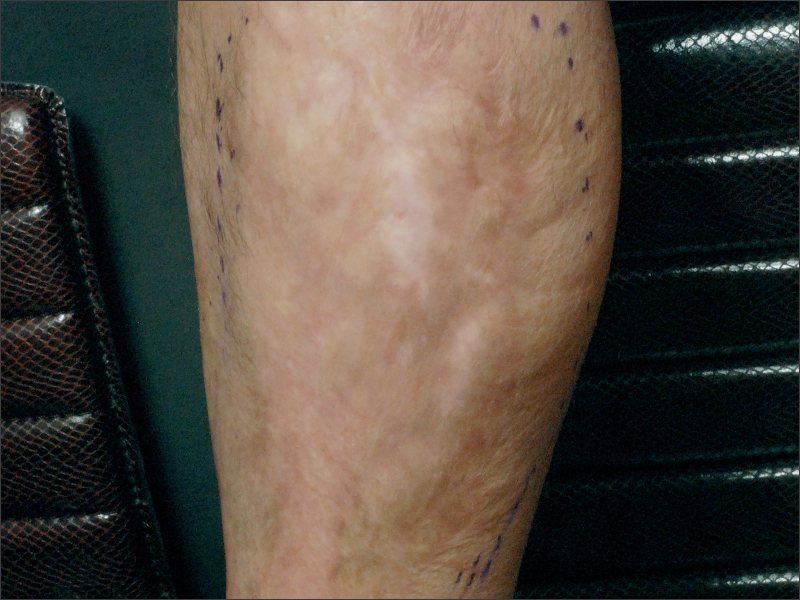 Burn scar before treatment at Yonsei Star Dermatology