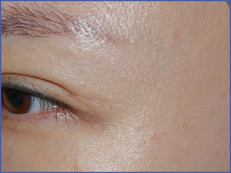 Double-eyelid surgery scar after treatment at Yonsei Star Dermatology