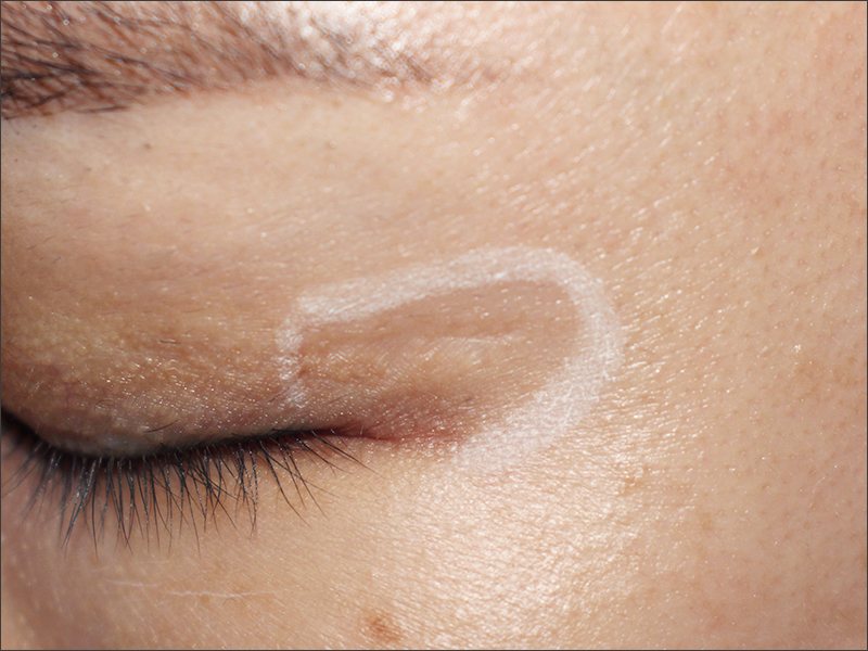 Double-eyelid surgery scar before treatment at Yonsei Star Dermatology