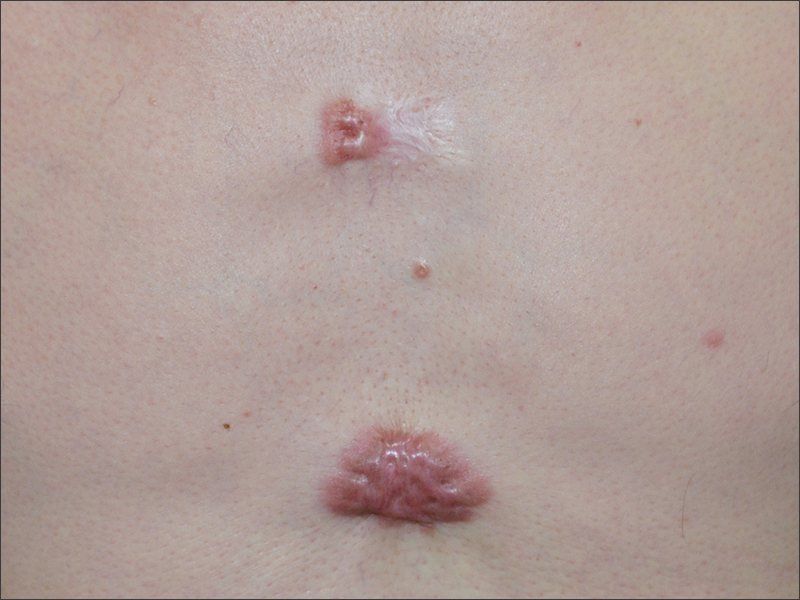 Keloid scar after treatment at Yonsei Star Dermatology