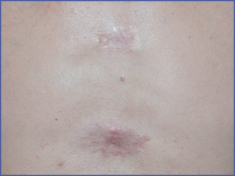 Keloid scar before treatment at Yonsei Star Dermatology