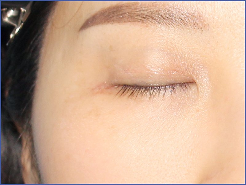 Melasma after