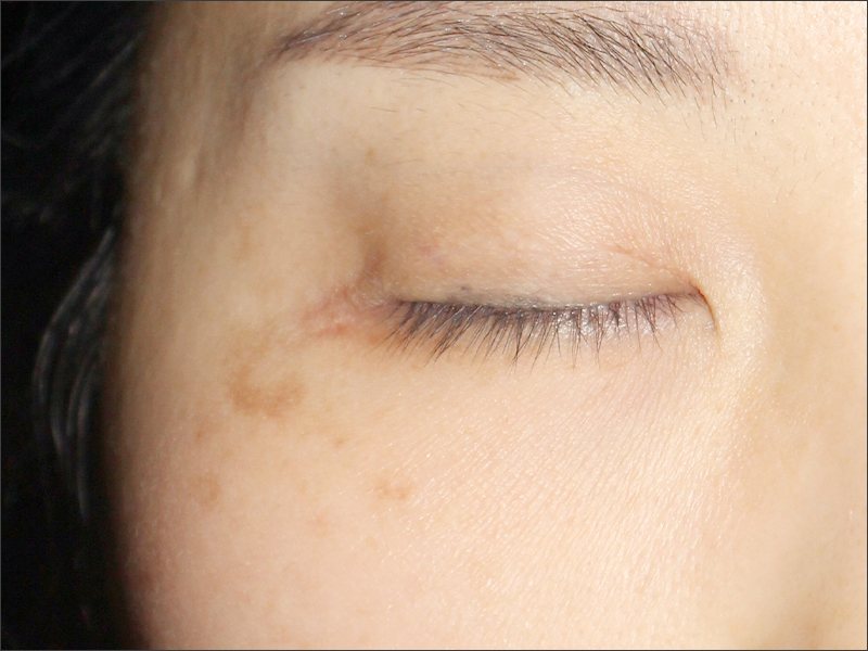 Melasma before