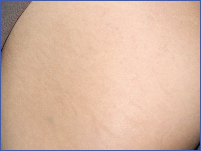 White stretch marks after treatment at Yonsei Star Dermatology
