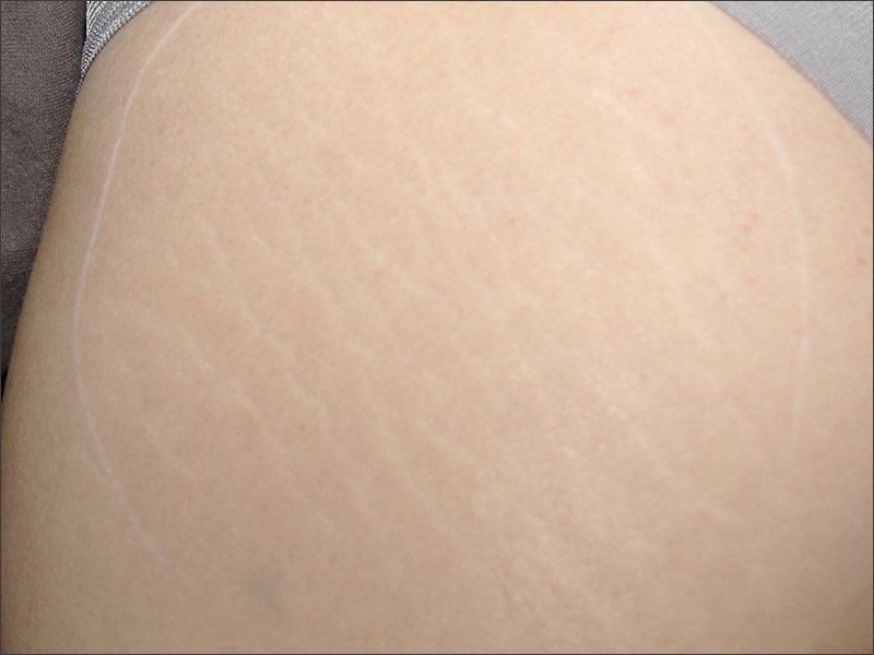 White stretch marks before treatment at Yonsei Star Dermatology