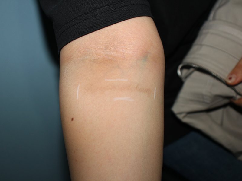Tattoo removal after treatment at Yonsei Star Dermatology