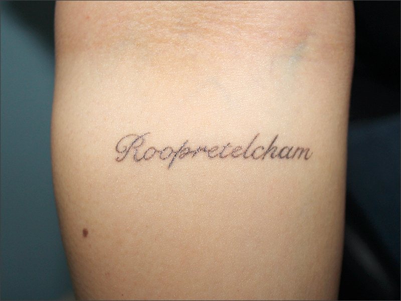 Tattoo removal before treatment at Yonsei Star Dermatology